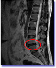 herniated and/or Bulging Discs - Oak Ridge Salama Chropractic Center